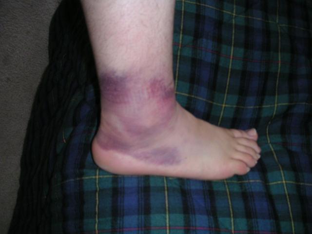 My ankle after twisting it while moving Lisa